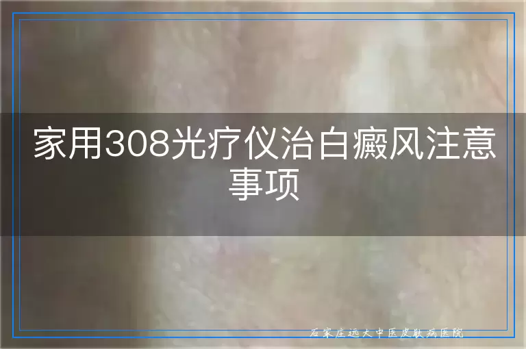 家用308光疗仪治白癜风注意事项