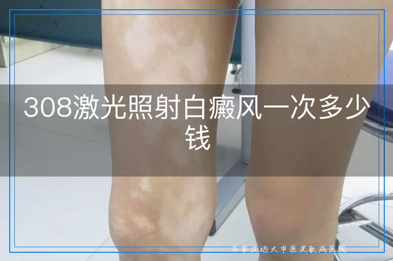 308激光照射白癜风一次多少钱