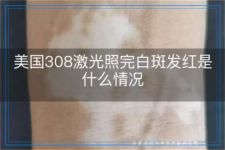 美国308激光照完白斑发红是什么情况