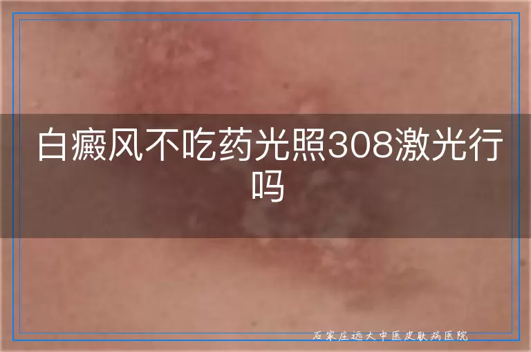 白癜风不吃药光照308激光行吗