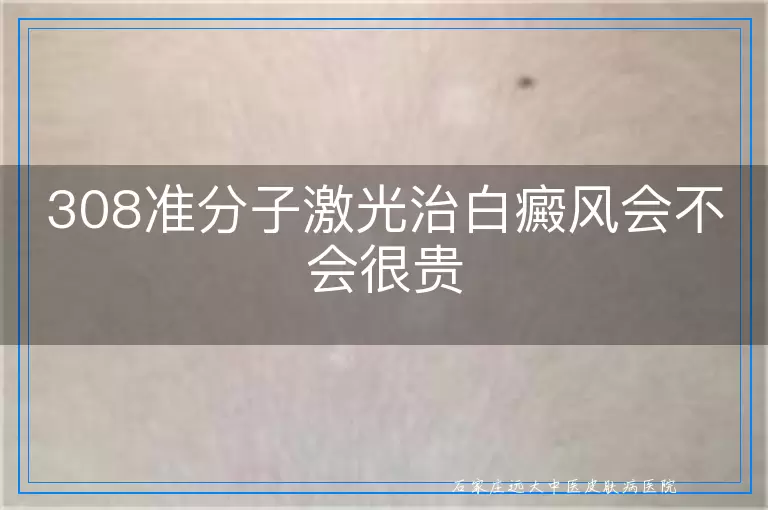 308准分子激光治白癜风会不会很贵