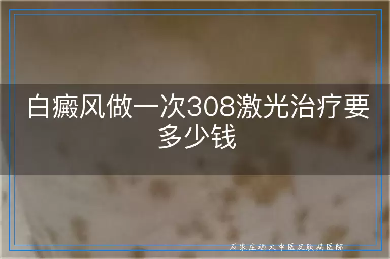 白癜风做一次308激光治疗要多少钱