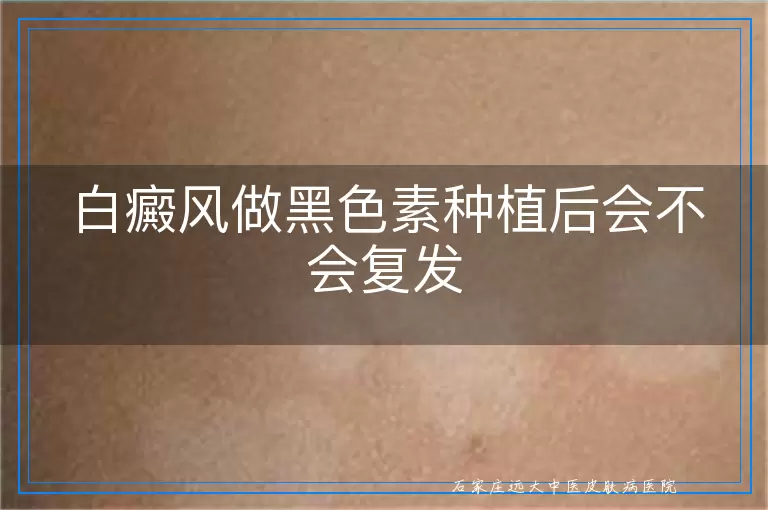 白癜风做黑色素种植后会不会复发