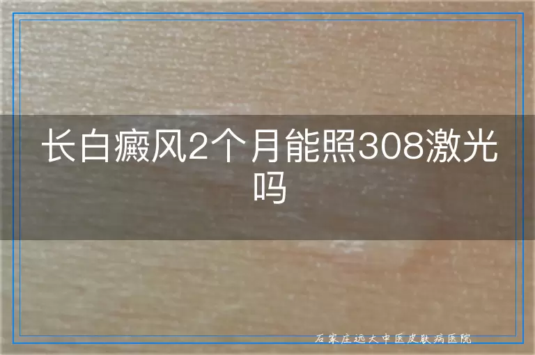 长白癜风2个月能照308激光吗