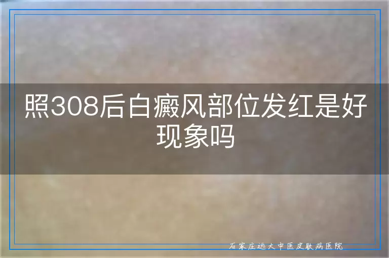照308后白癜风部位发红是好现象吗