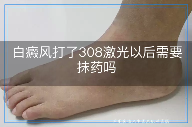 白癜风打了308激光以后需要抹药吗