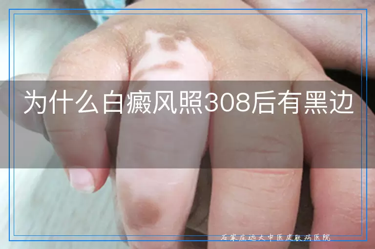为什么白癜风照308后有黑边