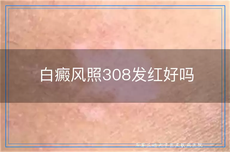 白癜风照308发红好吗