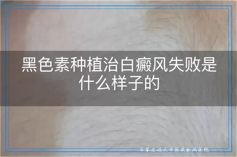 黑色素种植治白癜风失败是什么样子的