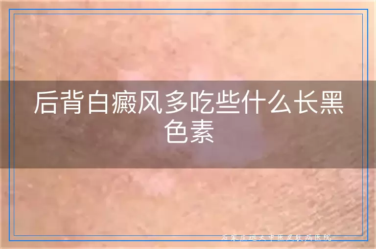 后背白癜风多吃些什么长黑色素