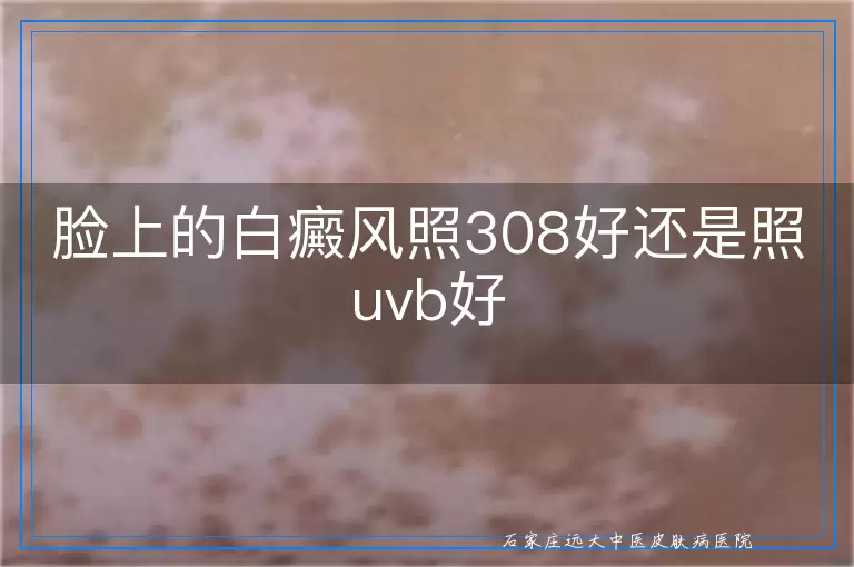 脸上的白癜风照308好还是照uvb好