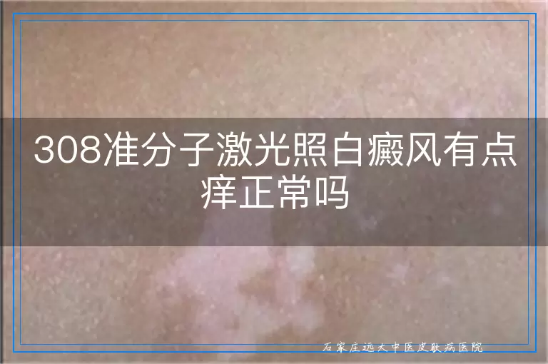308准分子激光照白癜风有点痒正常吗