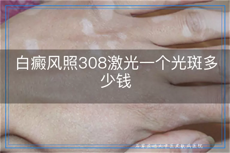 白癜风照308激光一个光斑多少钱