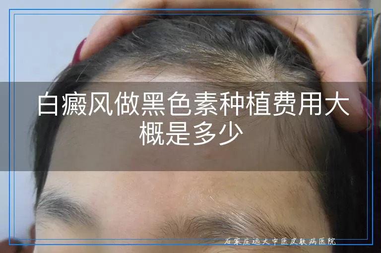 白癜风做黑色素种植费用大概是多少