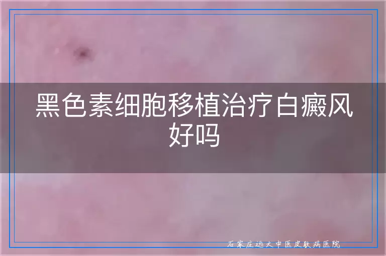 黑色素细胞移植治疗白癜风好吗