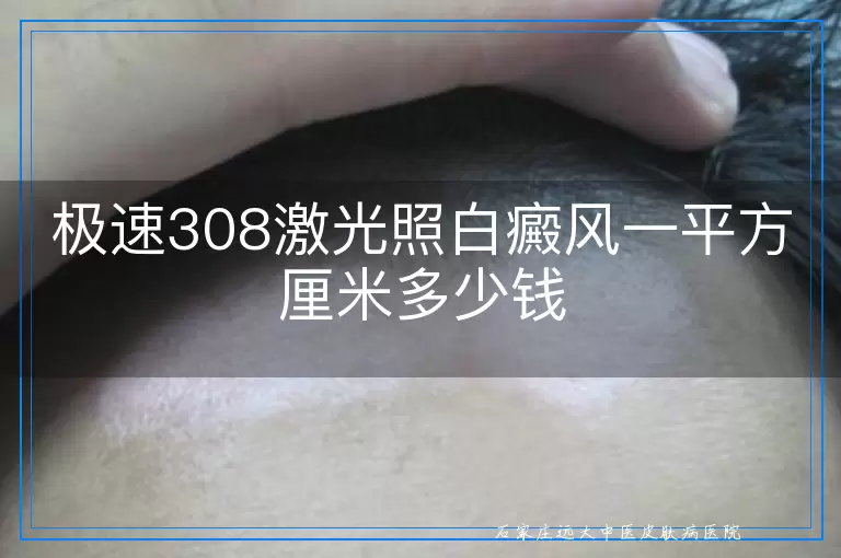 极速308激光照白癜风一平方厘米多少钱