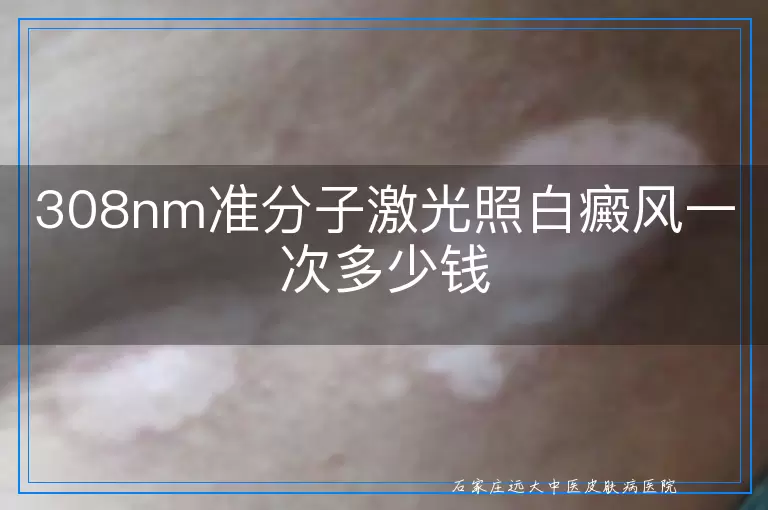 308nm准分子激光照白癜风一次多少钱