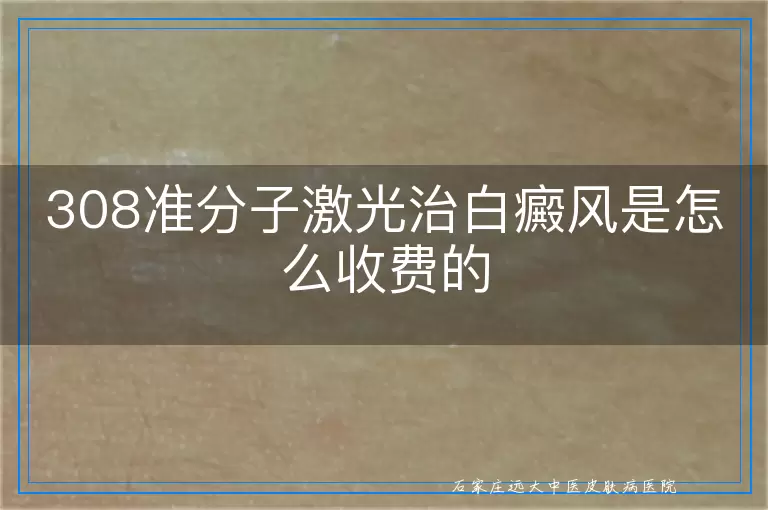 308准分子激光治白癜风是怎么收费的