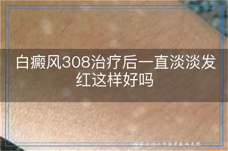 白癜风308治疗后一直淡淡发红这样好吗