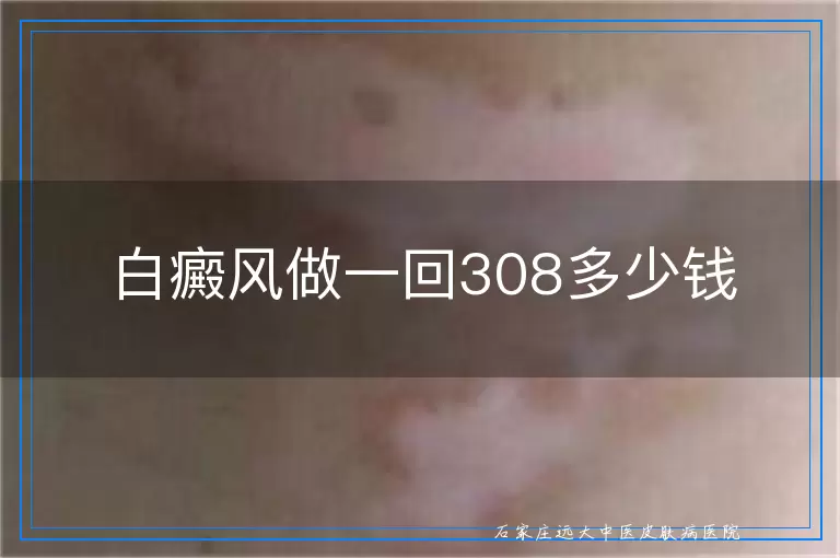 白癜风做一回308多少钱