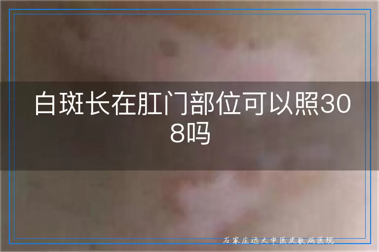 白斑长在肛门部位可以照308吗