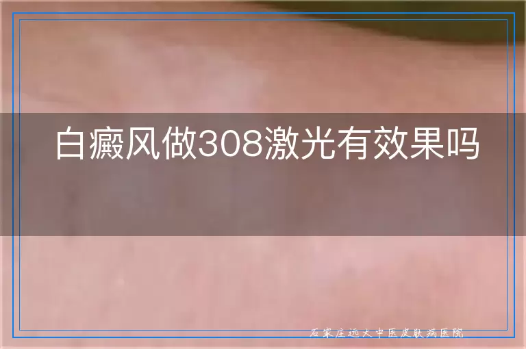 白癜风做308激光有效果吗