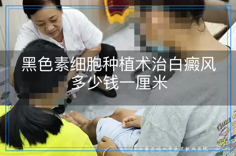 黑色素细胞种植术治白癜风多少钱一厘米