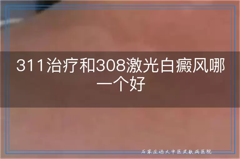 311治疗和308激光白癜风哪一个好