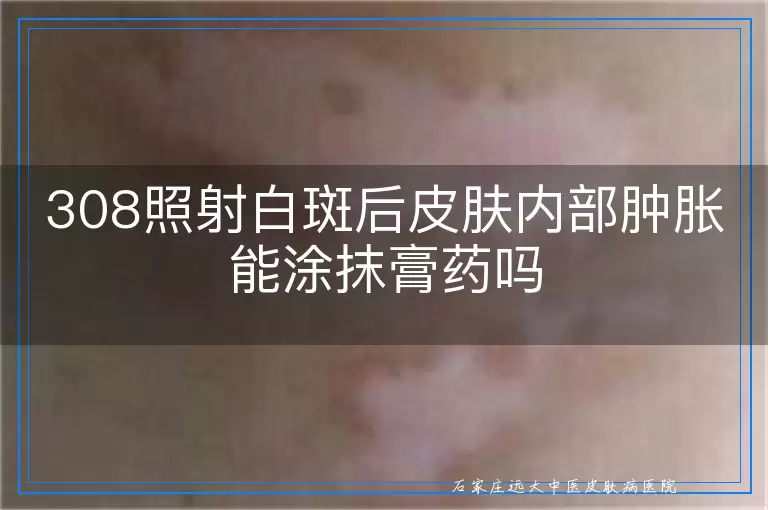308照射白斑后皮肤内部肿胀能涂抹膏药吗