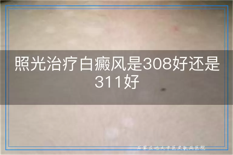 照光治疗白癜风是308好还是311好