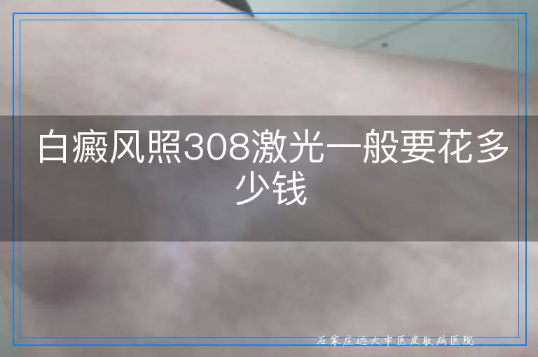 白癜风照308激光一般要花多少钱