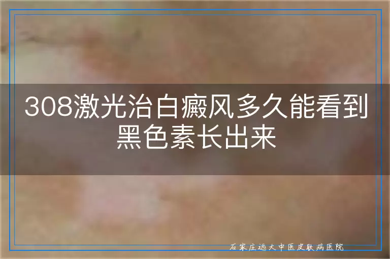 308激光治白癜风多久能看到黑色素长出来