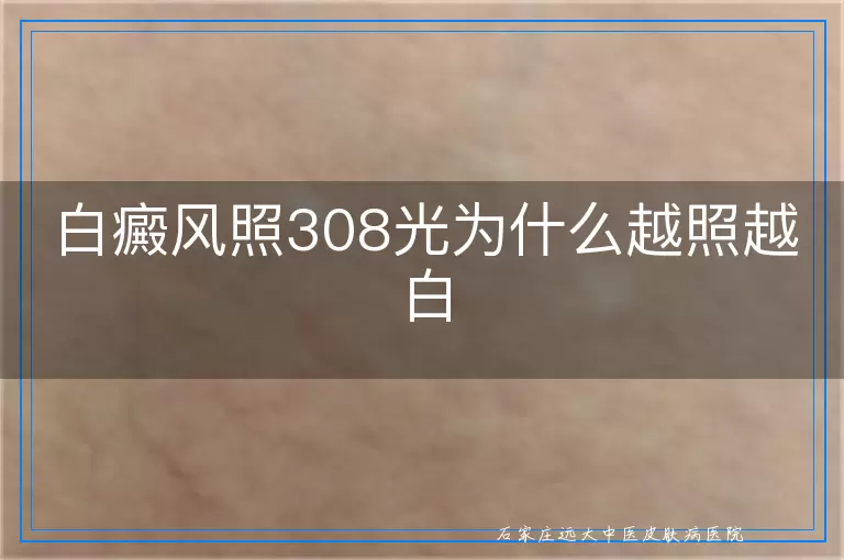 白癜风照308光为什么越照越白