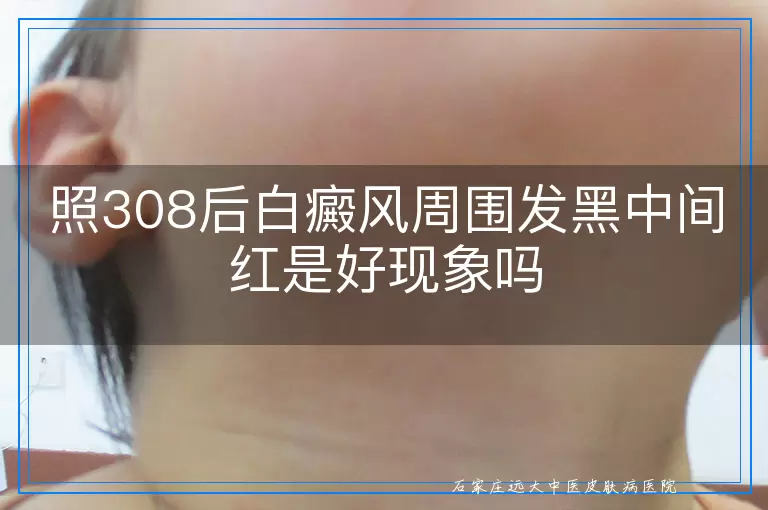 照308后白癜风周围发黑中间红是好现象吗