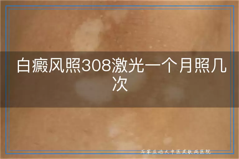 白癜风照308激光一个月照几次