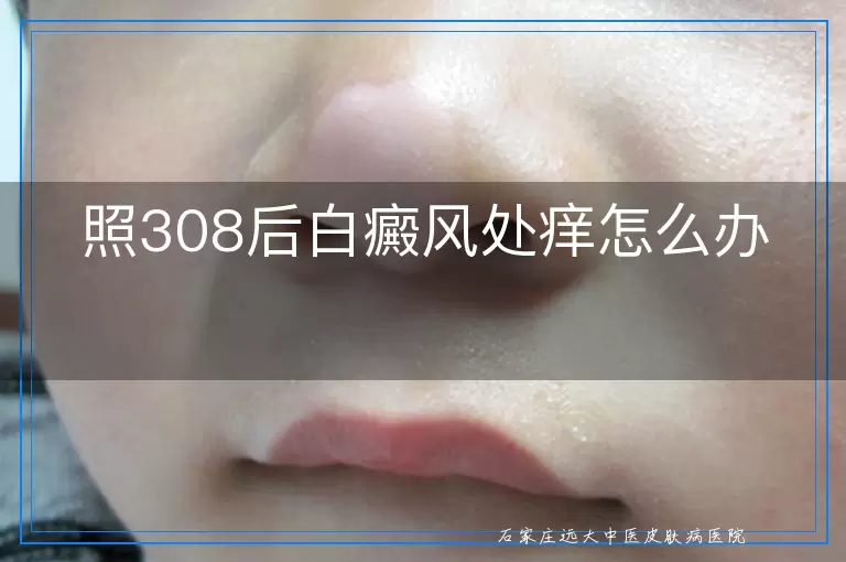 照308后白癜风处痒怎么办