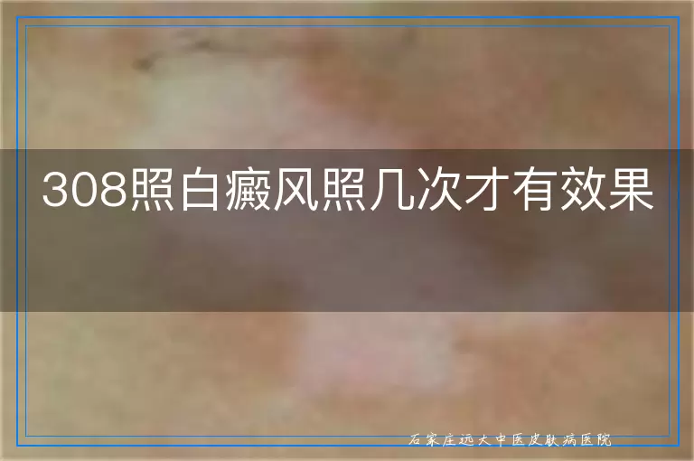 308照白癜风照几次才有效果
