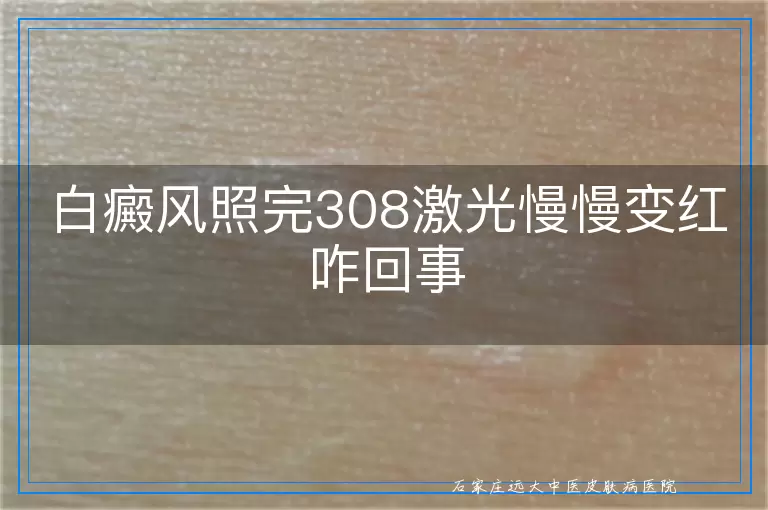 白癜风照完308激光慢慢变红咋回事