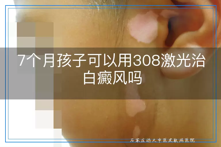 7个月孩子可以用308激光治白癜风吗