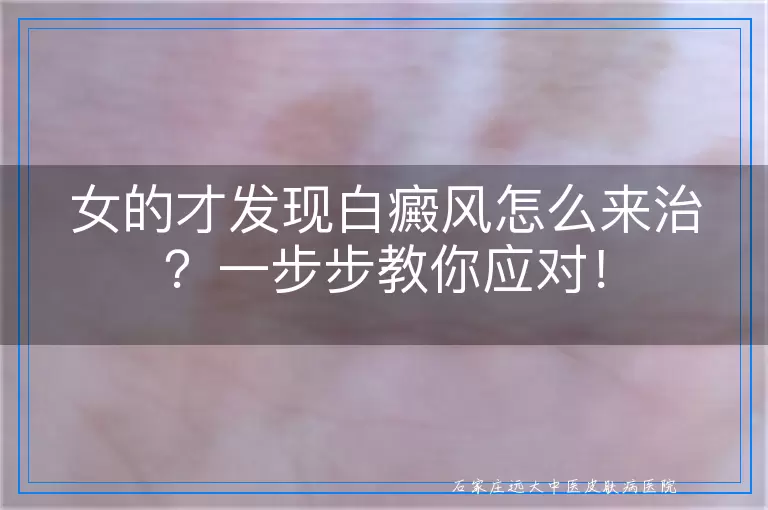 女的才发现白癜风怎么来治？一步步教你应对！