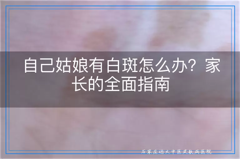 自己姑娘有白斑怎么办？家长的全面指南