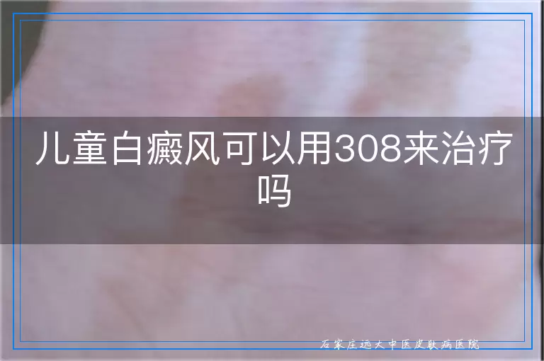 儿童白癜风可以用308来治疗吗