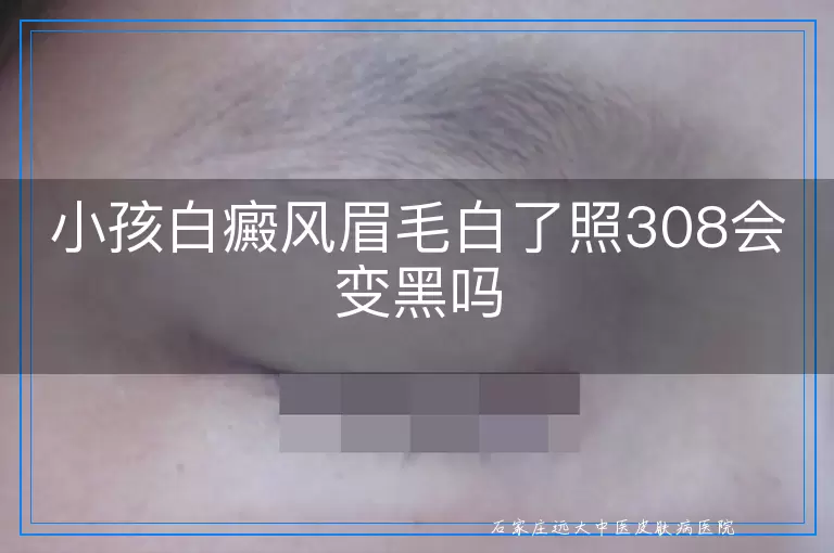 小孩白癜风眉毛白了照308会变黑吗