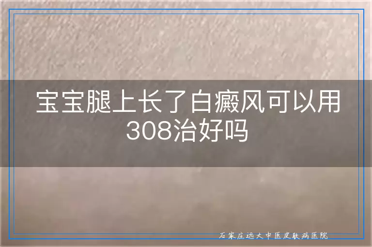 宝宝腿上长了白癜风可以用308治好吗