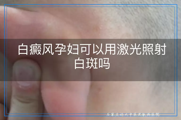 白癜风孕妇可以用激光照射白斑吗