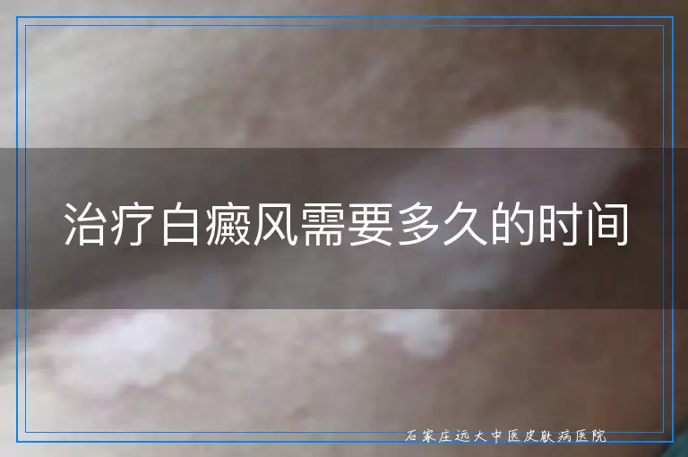 治疗白癜风需要多久的时间