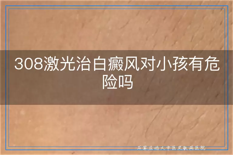 308激光治白癜风对小孩有危险吗