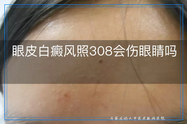 眼皮白癜风照308会伤眼睛吗