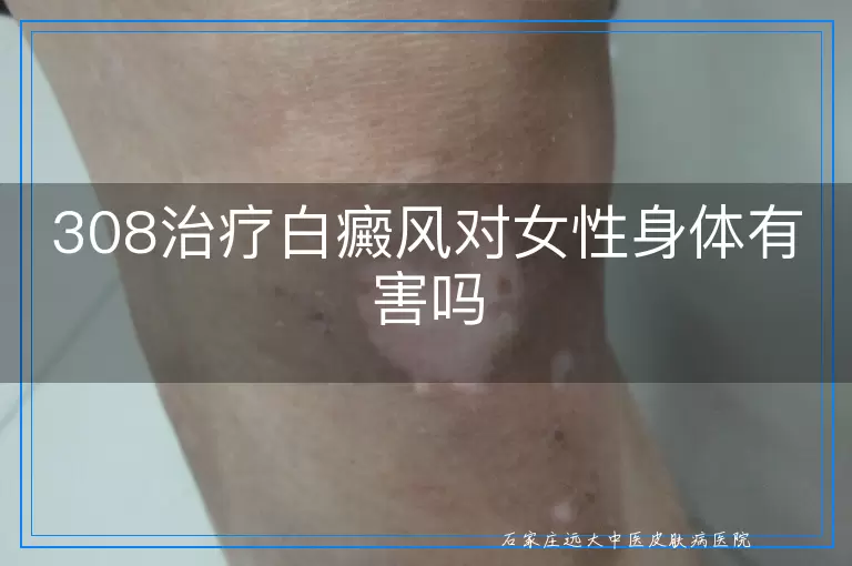 308治疗白癜风对女性身体有害吗
