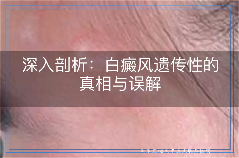 深入剖析：白癜风遗传性的真相与误解